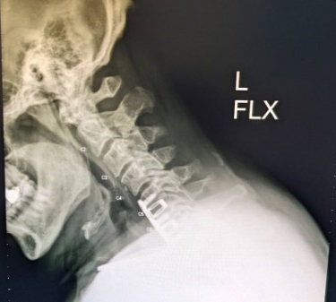 Name:  Neck X-Ray, L-Flex, Jun 2022 - cropped.jpg
Views: 933
Size:  30.2 KB